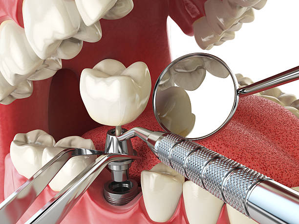 Best Emergency Treatment for Dental Infections or Abscesses in Marionville, MO